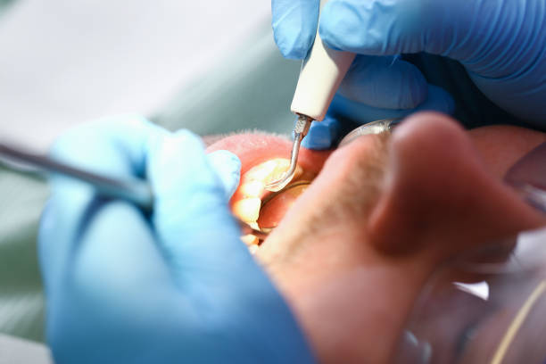 Best Chipped Tooth Repair Near Me  in Seven Points, TX